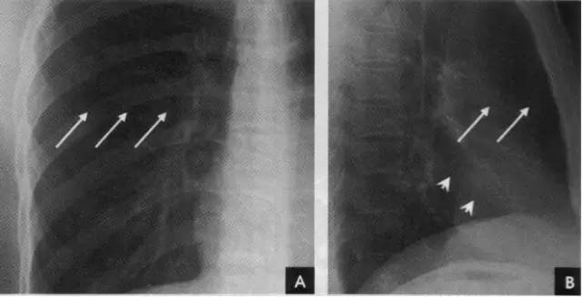 胸部ct解剖结构,胸部x线解读视频