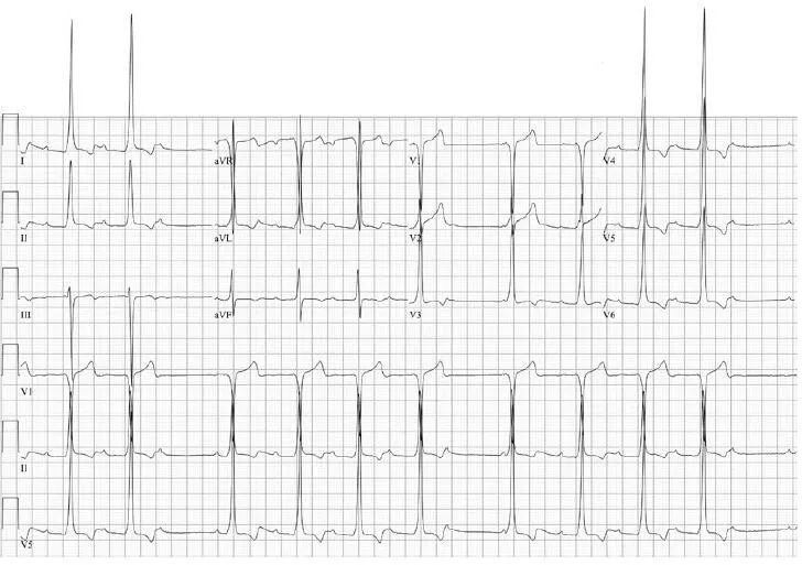 预激房颤,房颤没症状需要射频消融吗