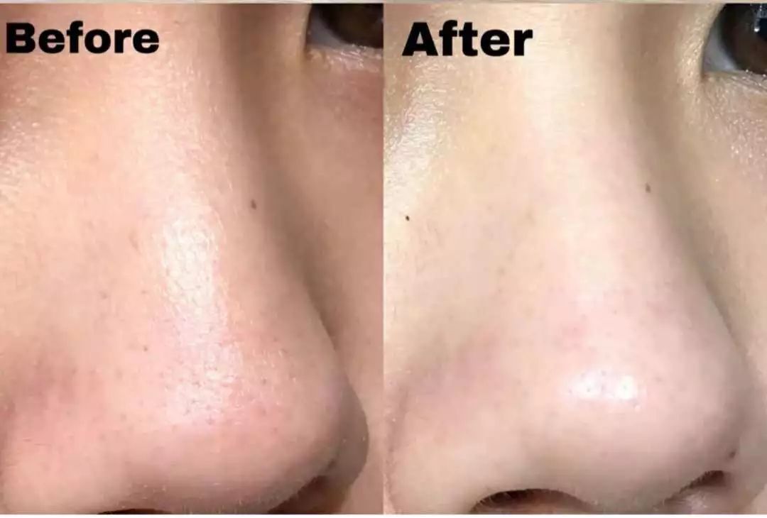 拯救毛孔黑头,清除黑头大毛孔的利器