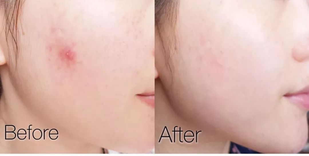 拯救毛孔黑头,清除黑头大毛孔的利器