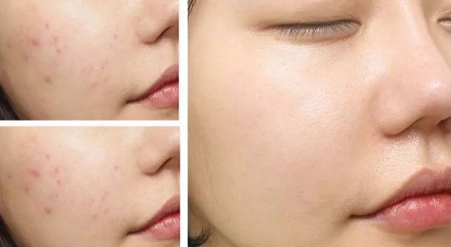 断货王祛痘胶囊,秒杀祛痘化妆品一元