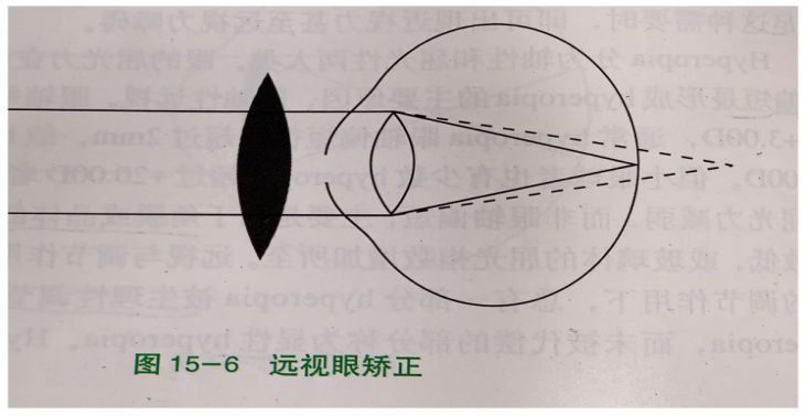 医生说孩子眼球不正常,医生诊断屈光不正是什么意思