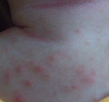 治疗痱子的8个妙招,有关治痱子的小妙招