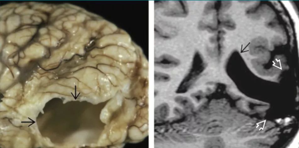 多图多表：带你识别颅内囊肿的影像学表现丨实战读片