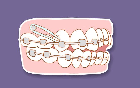别人矫牙1万起,广州只要3960元!仅限2天
