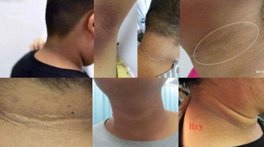 女孩脖子黑且洗不干净怎么回事,脖子一圈黑黑的跟没洗干净似的