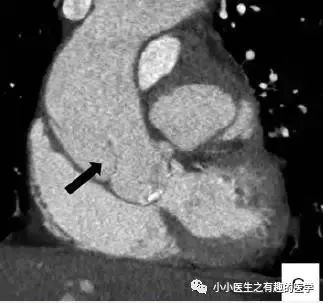 肺动脉分支充盈欠佳是肺栓塞吗,肺动脉缺损不可逆