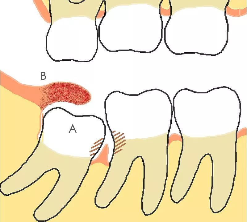 你需要了解关于智齿的这七个问题,智齿只剩牙根拔智齿的全过程