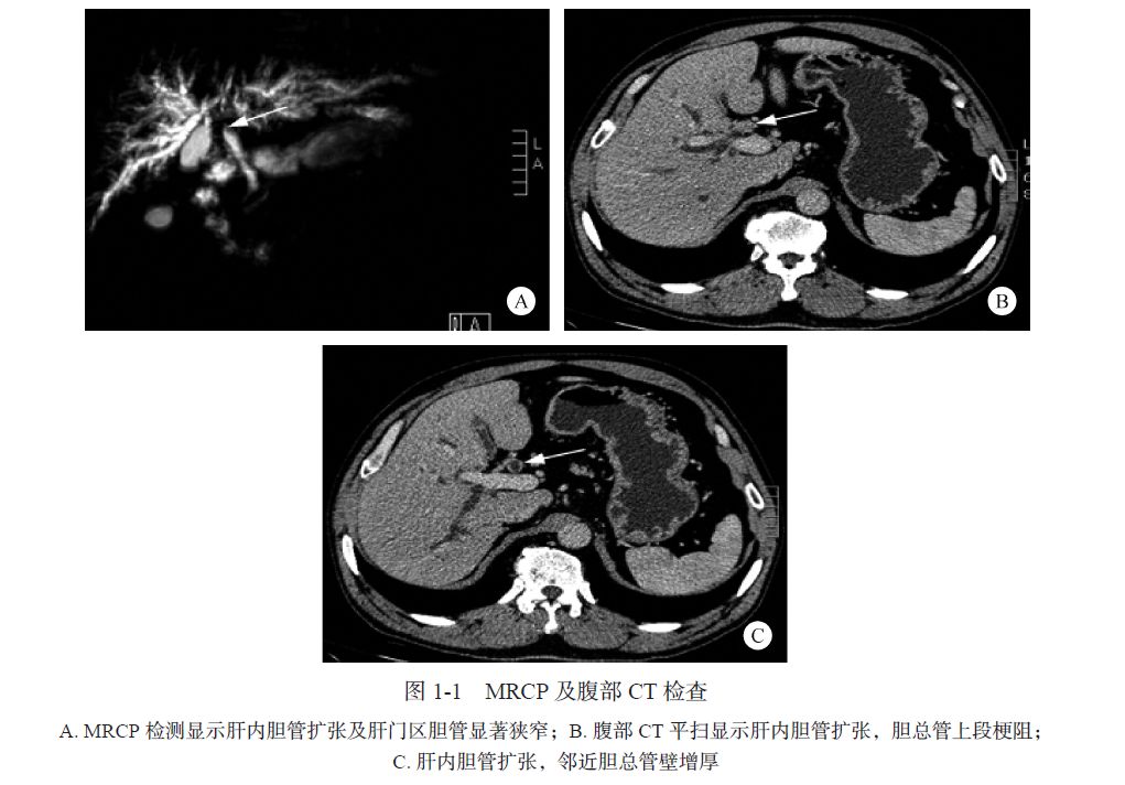 igg4疾病胆管炎会引起ca199升高吗,igg4相关性胰腺胆管炎