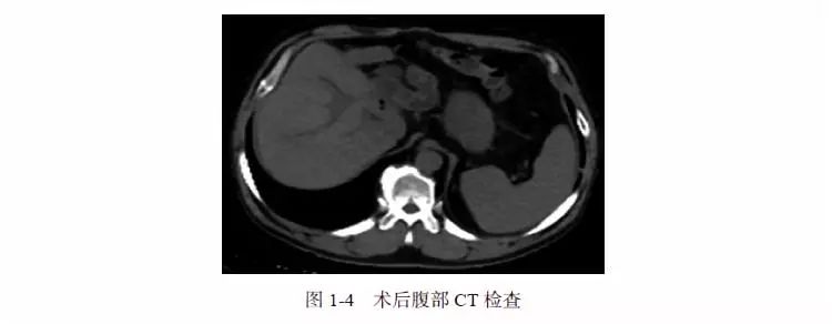 igg4疾病胆管炎会引起ca199升高吗,igg4相关性胰腺胆管炎