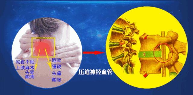 富贵包导致脖子筋痛用什么治疗,富贵包消除的最佳神器