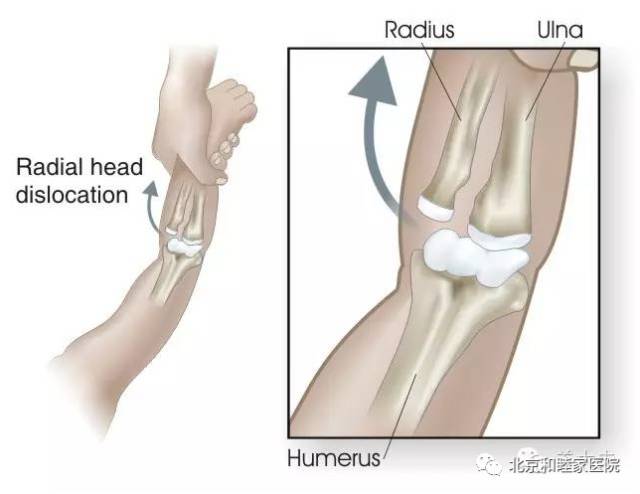 怎么牵宝宝胳膊防止脱臼,牵拉孩子的正确方式