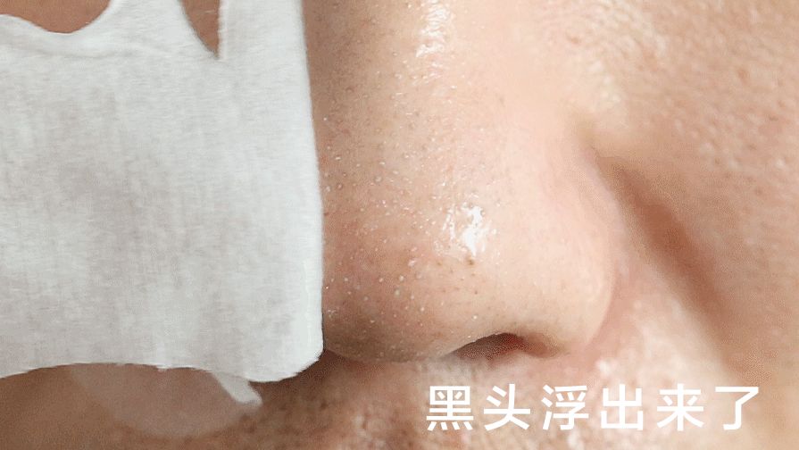 严重的黑头怎么处理教程,反复黑头的原因和解决方法