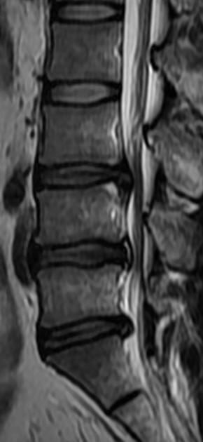 一分钟带你了解腰椎狭窄,椎管狭窄症知识大全