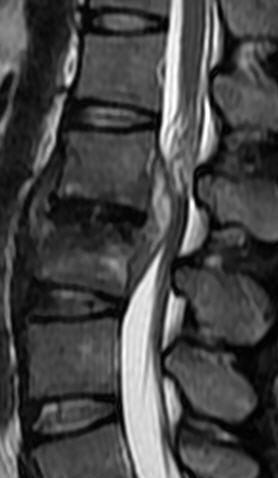 一分钟带你了解腰椎狭窄,椎管狭窄症知识大全