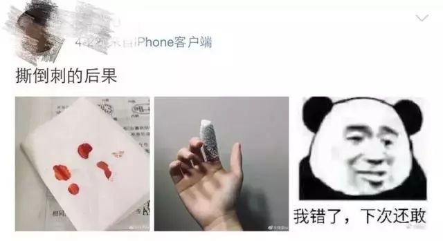 一个没注意,手指倒刺变截指!这个动作千万别再做了!