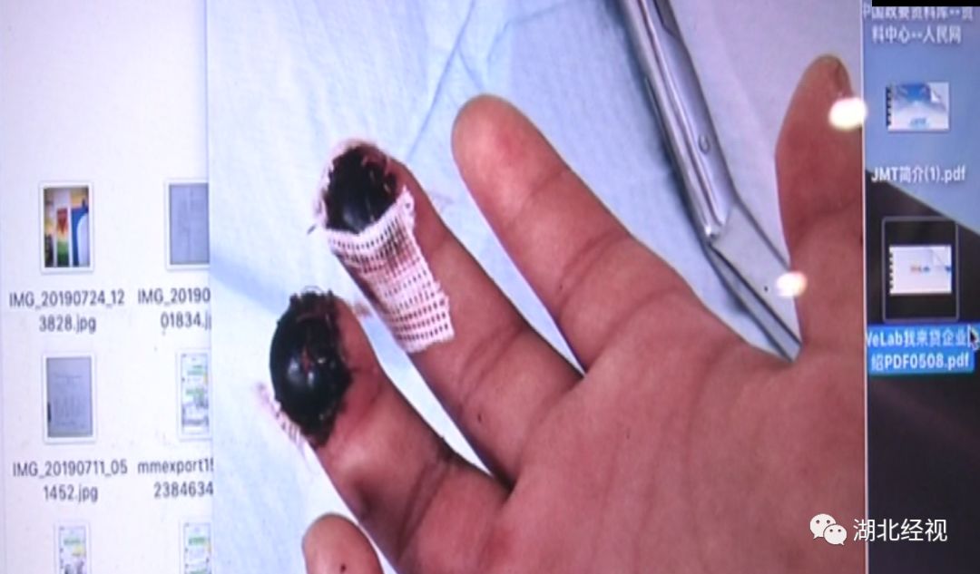 培训课堂上桌子倾倒，5岁女孩2根手指受伤！指腹坏死，后期还需要多次手术