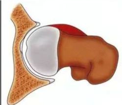 股骨头坏死保髋手术能撑几年,股骨头坏死的保髋治疗