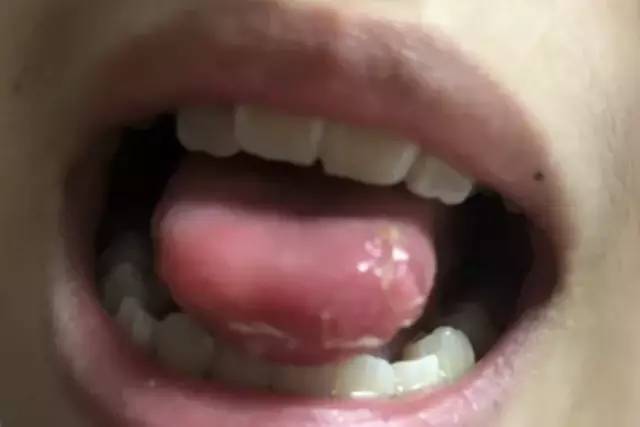 补牙舌头底下破了个洞,补牙把舌头弄破了需要怎么处理