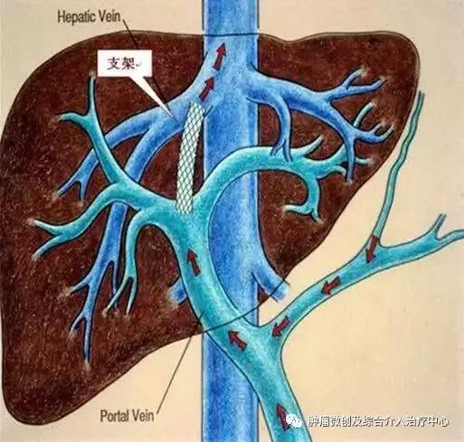 大咯血的抢救药物,支扩栓塞止血后大咯血还会复发吗