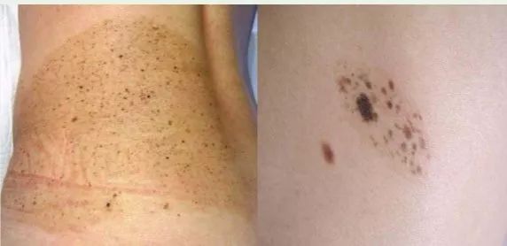 雀斑样痣和雀斑的区别有哪些,雀斑和青褐色痣