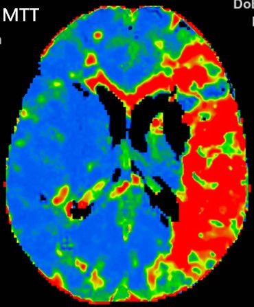 Reco特约·第10期｜国产组合助力取栓“一把通”——Ewata球囊导引导管联合Reco支架取栓分享