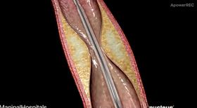 心脏造影和支架一起做大概多少钱,心脏造影支架视频全过程