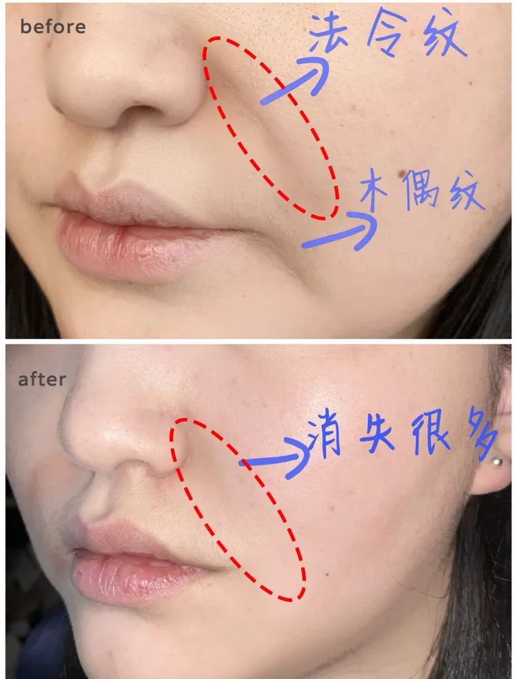 三十岁就有眉间纹法令纹怎么办,30岁法令纹眉心纹深