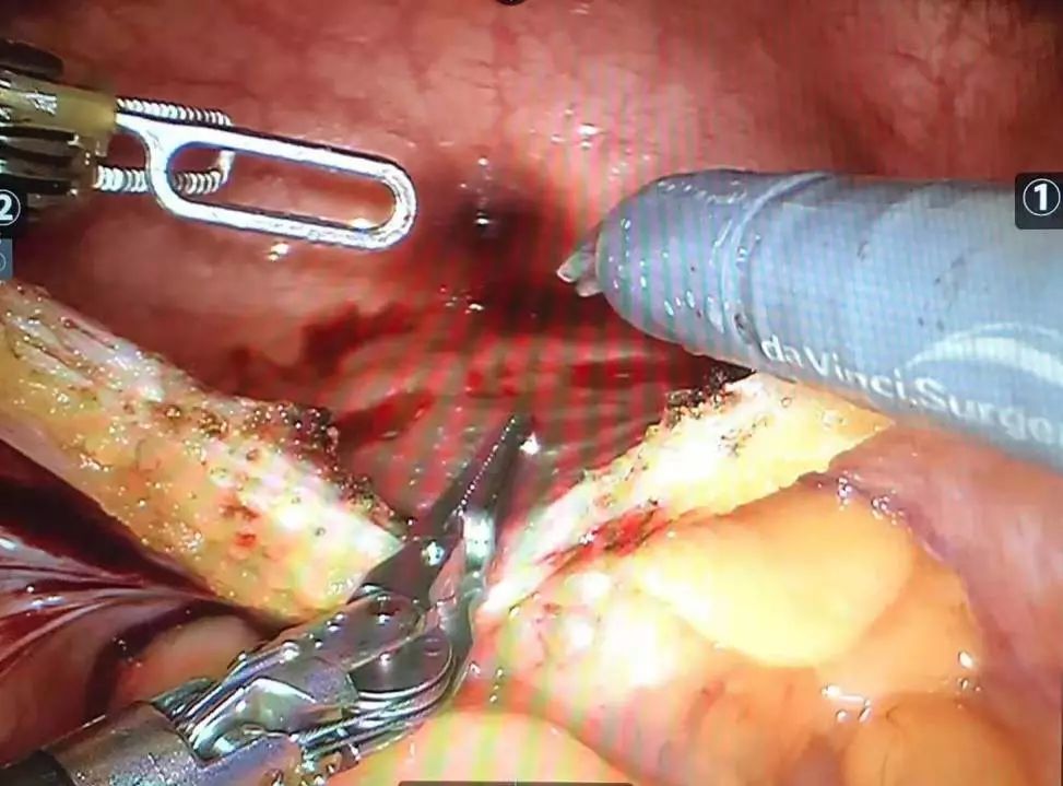 得了前列腺癌，一天就被切干净出院了？！这个指标，男性要当心