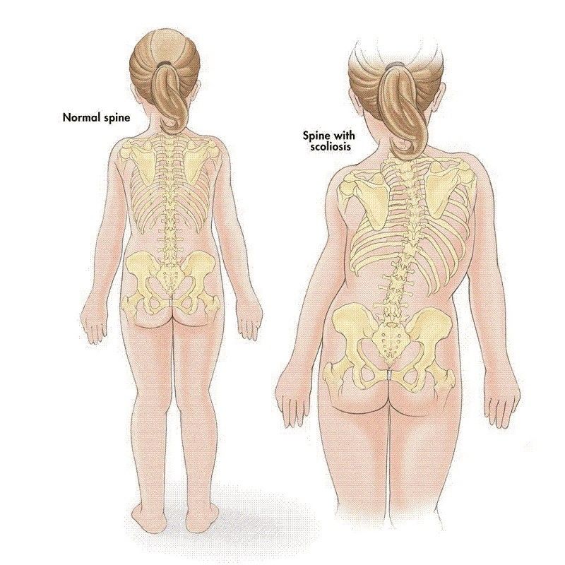 背书包驼背怎么纠正,小孩背书包导致驼背怎么矫正