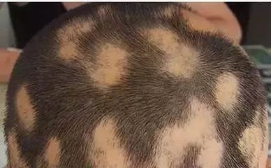 鬼剃头为什么没有掉下来的头发,鬼剃头了头发还能长出来吗