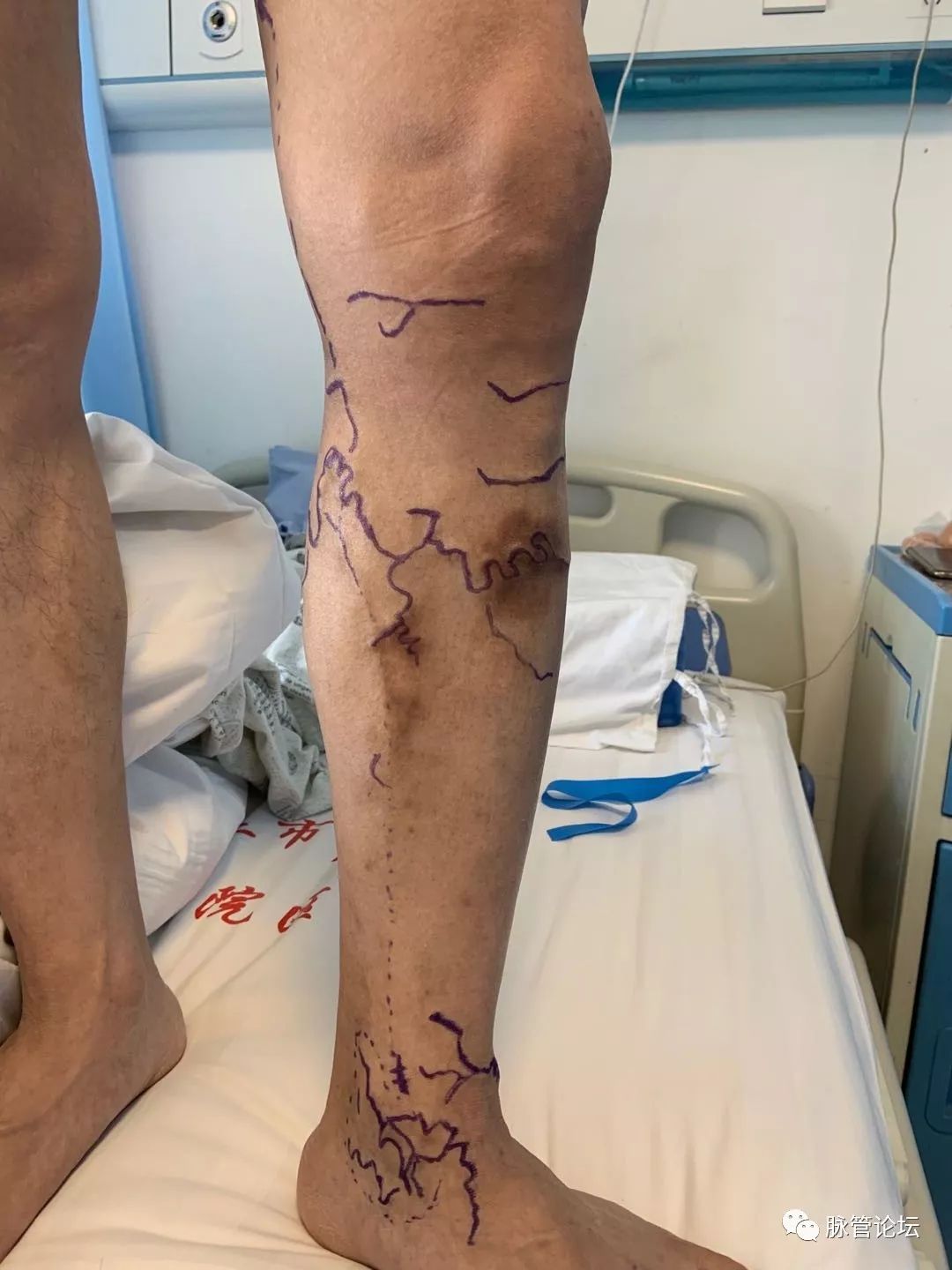 医生彻底根治静脉曲张的特效方法,广州中医治疗静脉曲张的10大忌