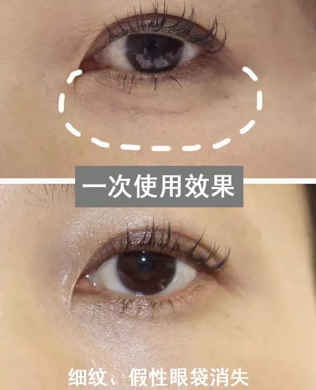 眼袋松弛下垂最快解决方法,严重眼袋下垂松弛怎么恢复