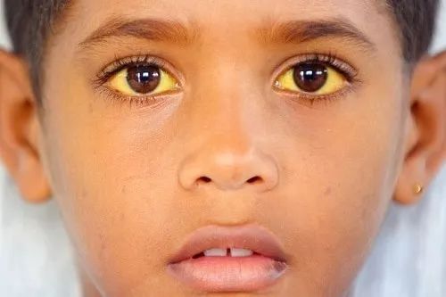 高胆红素脑病四大临床表现,胆红素高症状有哪些