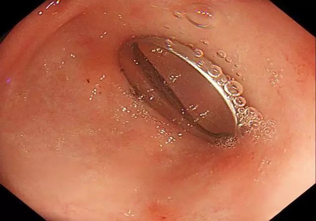 宝宝误吞妈妈急救,宝宝误吞了小扣子