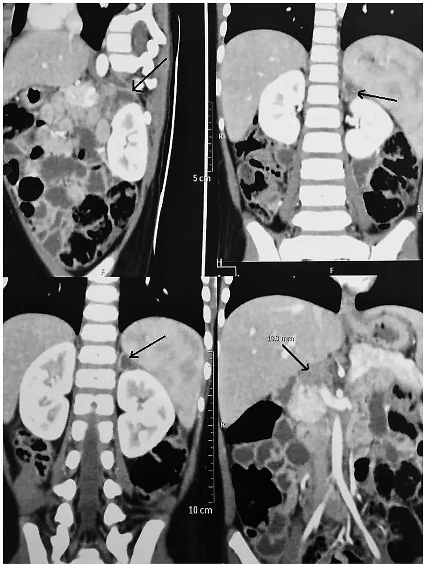 低血糖休克和过敏休克,低血糖休克的症状