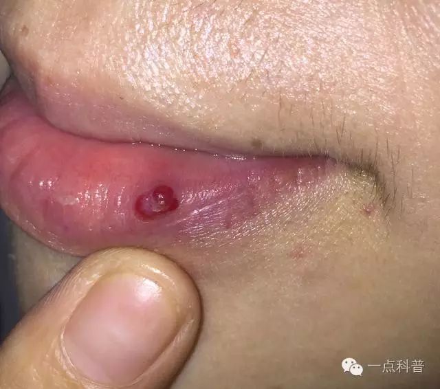 不要再撕嘴唇死皮了,很可能撕出这种病,会血流不止...