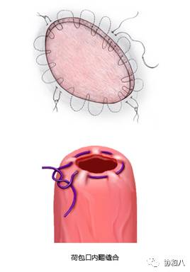 临行密密缝——不同缝合方法特点和适用条件（下）|朝花夕拾·协和八