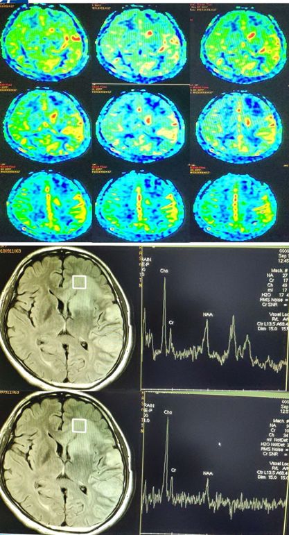 Rasmussen脑炎、结核性肉芽肿、脑发育性静脉畸形丨3分钟读片·第13期,下）