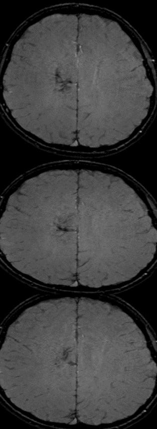 Rasmussen脑炎、结核性肉芽肿、脑发育性静脉畸形丨3分钟读片·第13期,下)
