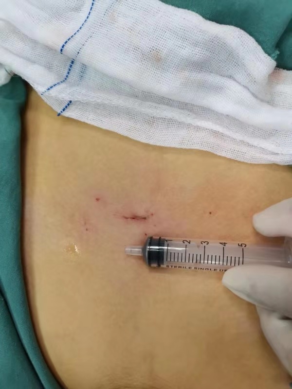 膀胱异物取出手术,哈尔滨看儿童泌尿科