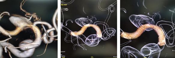 治疗颅内动脉瘤新型密网支架,密网支架处理动脉瘤的风险