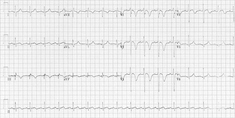 运动员t波改变怎么快速恢复正常,运动员会出现t波改变还能运动吗