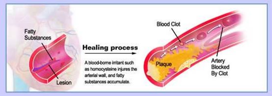 同型半胱氨酸健康科普涨知识,同型半胱氨酸怎样判断超标