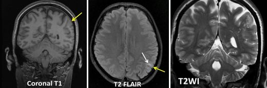 平山病、MELAS、MVNT、ODS丨3分钟读片·第15期