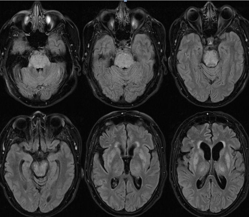 平山病、MELAS、MVNT、ODS丨3分钟读片·第15期