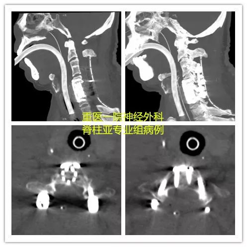 颈椎骨折脱位合并脊髓损伤,颈椎骨折脊髓损伤案例