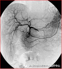 运城市第一医院介入科特色技术——肿瘤的化疗栓塞术