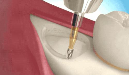 拔智齿的全过程科普,拔智齿细致操作过程