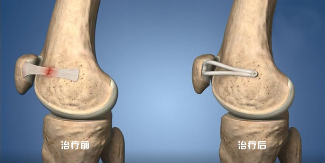 摔了一跤半月板二度撕裂,摔一跤膝盖半月板裂开了